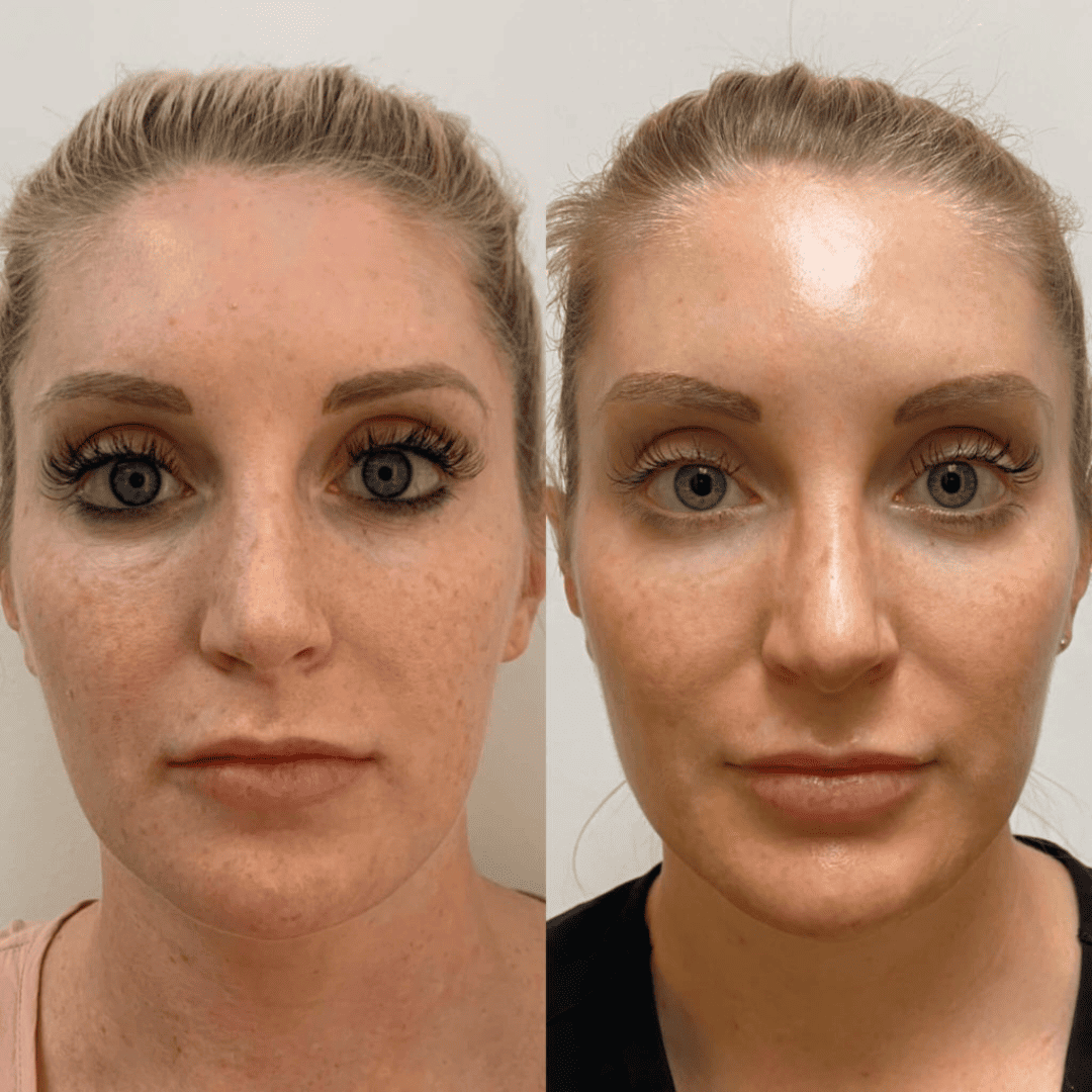 Skin texture and glow, before and after