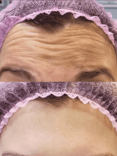 Forehead and frown lines, before and after
