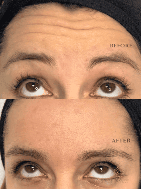 Forehead lines, before and after