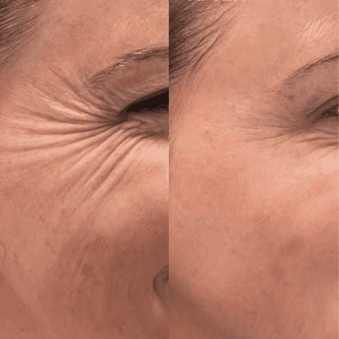 Crow's feet, before and after