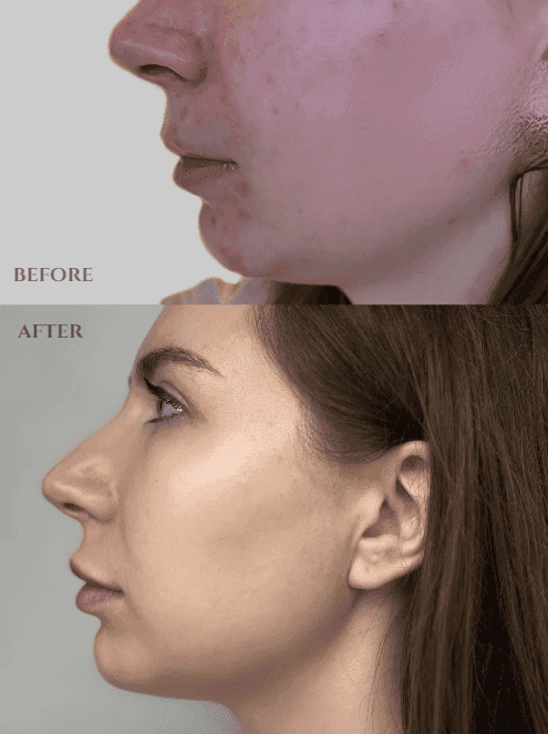 Cheek and jaw acne, calmed