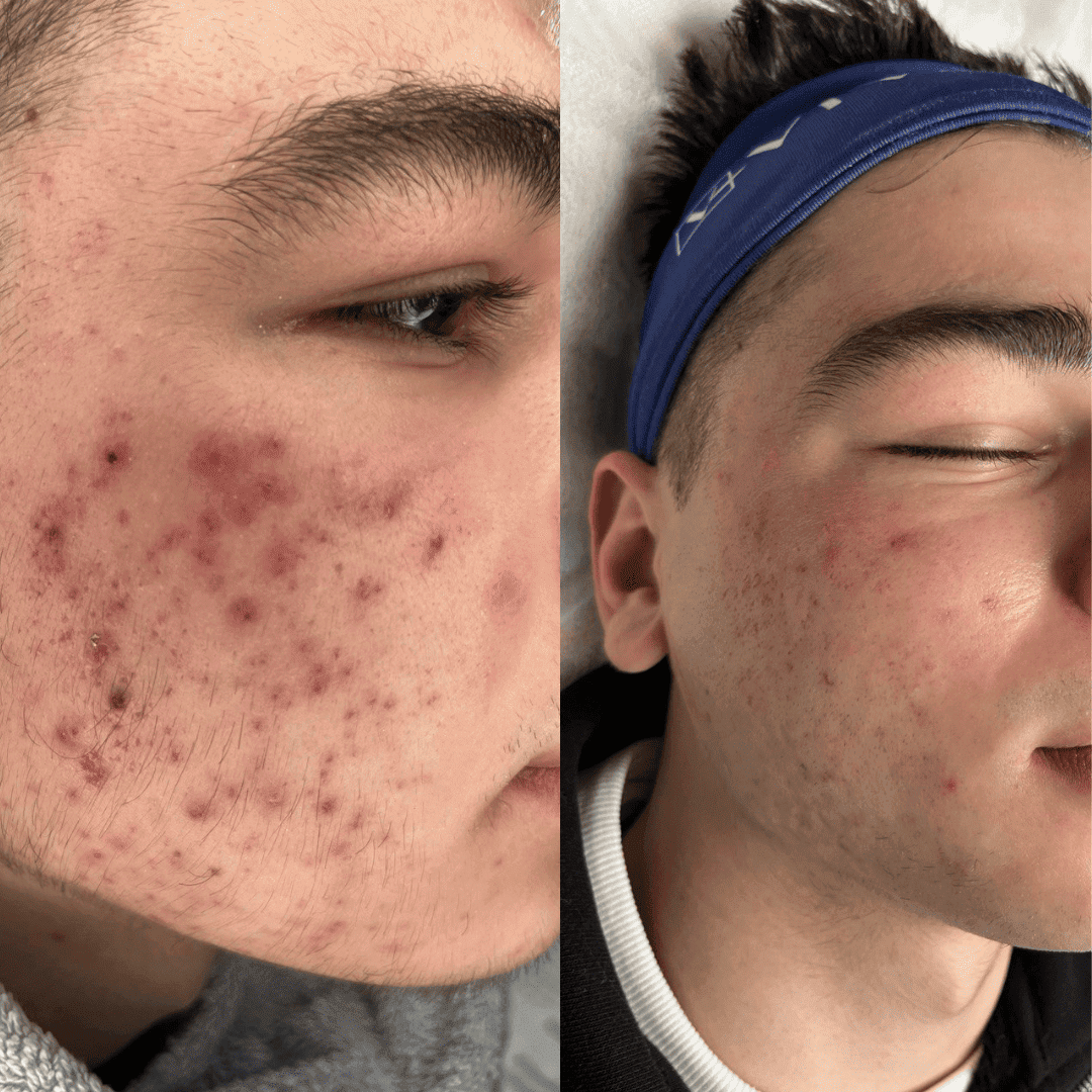 Inflammatory acne, cleared