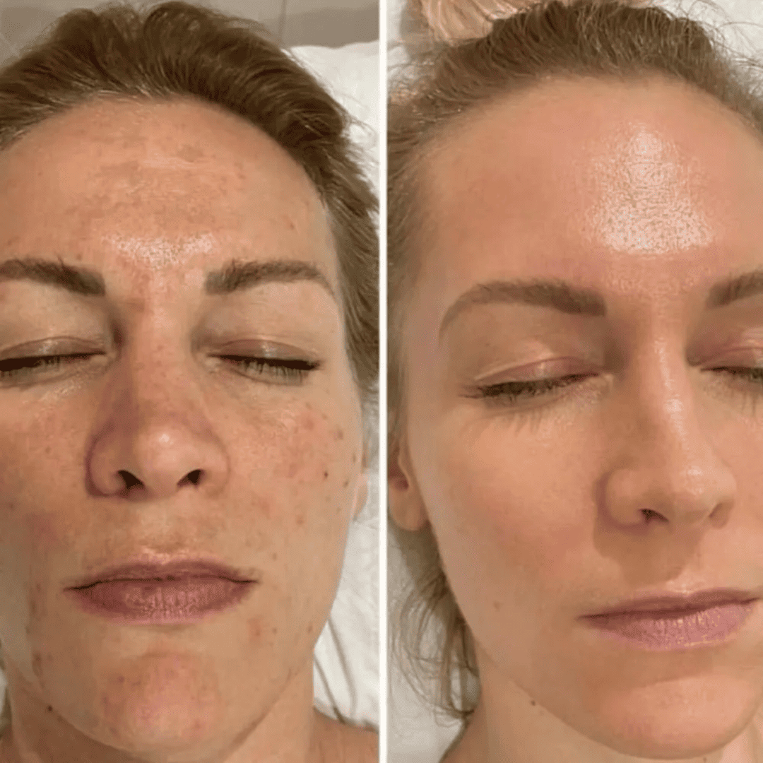 Dullness and glow, before and after