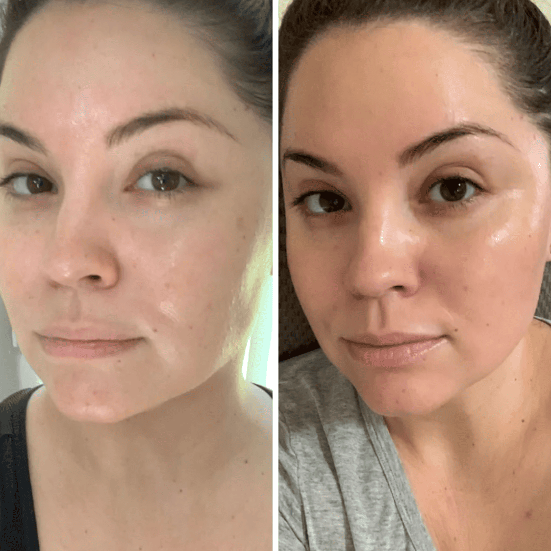 Pigmentation and sun damage, before and after