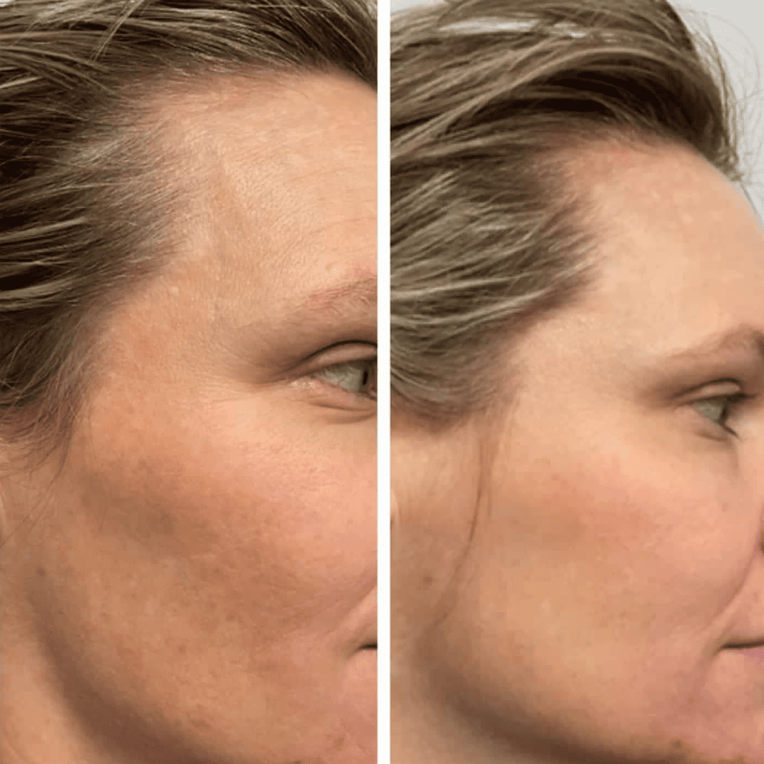 Texture and fine lines, before and after