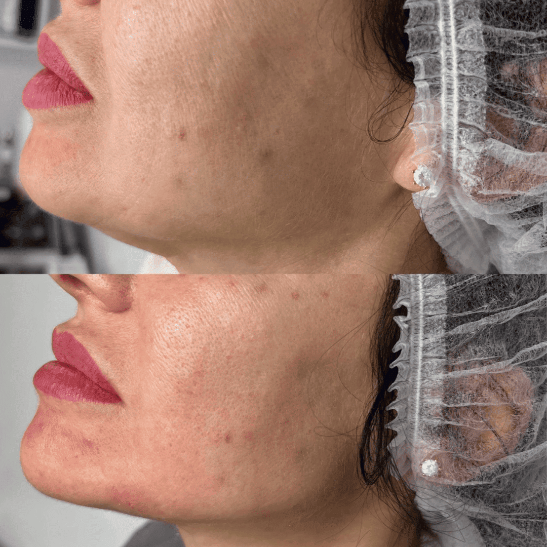 Under-eyes, cheeks and lips, before and after