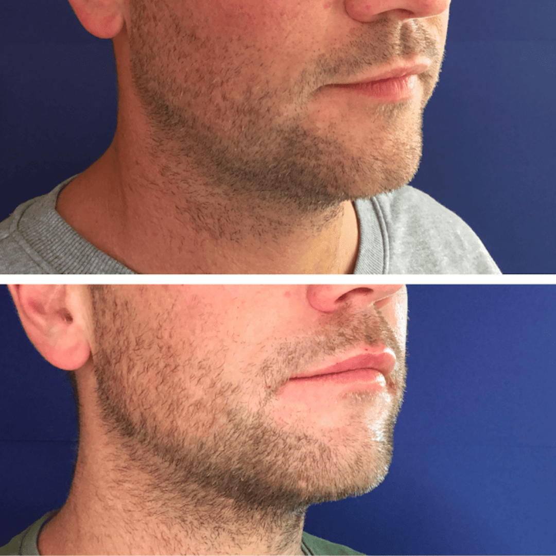 Double chin profile, before and after