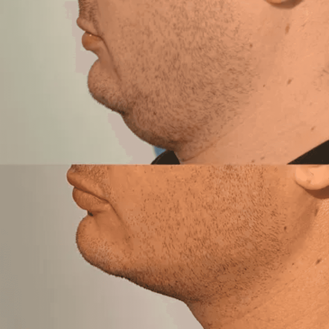 Chin and neck contour, before and after