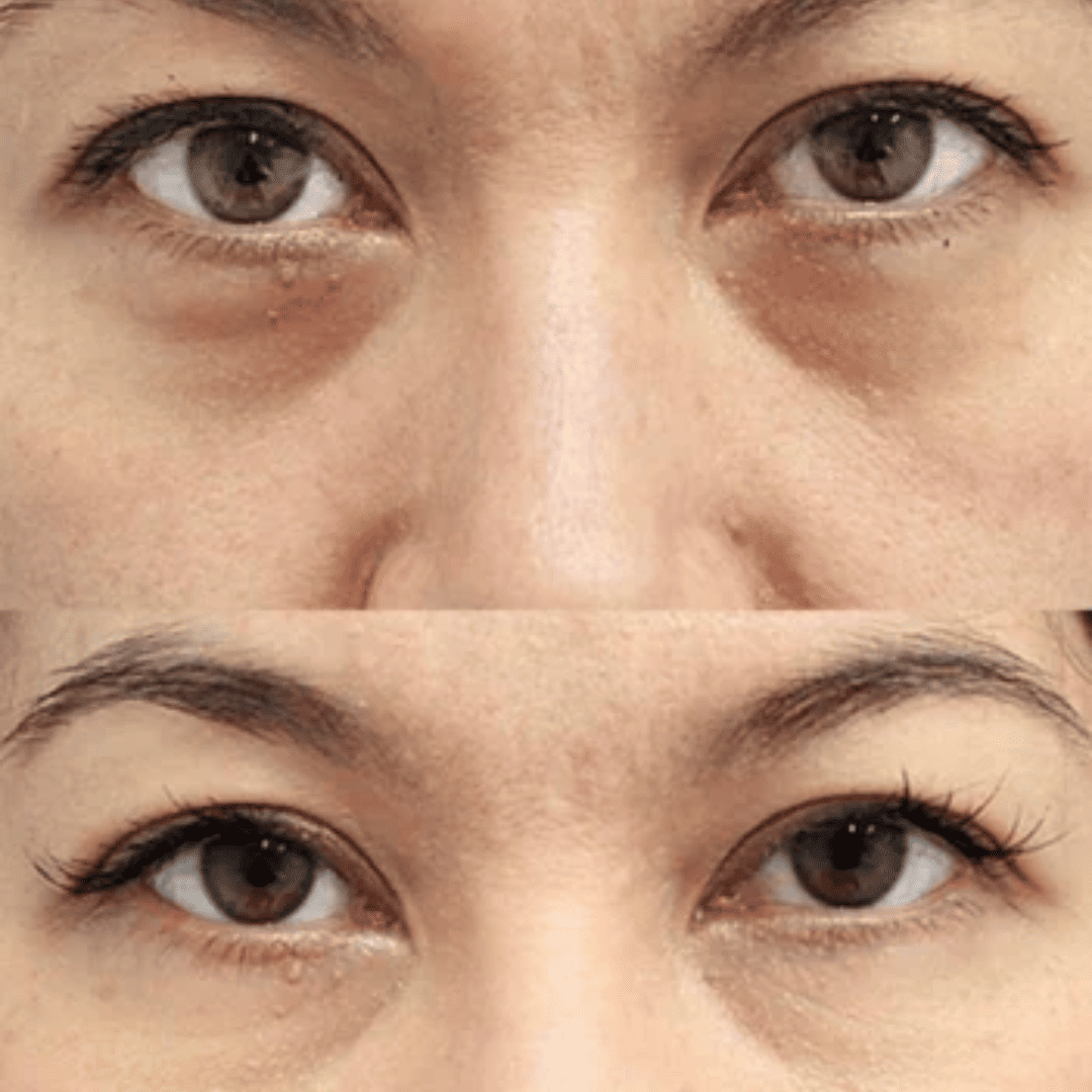 Eye bags and puffiness, before and after