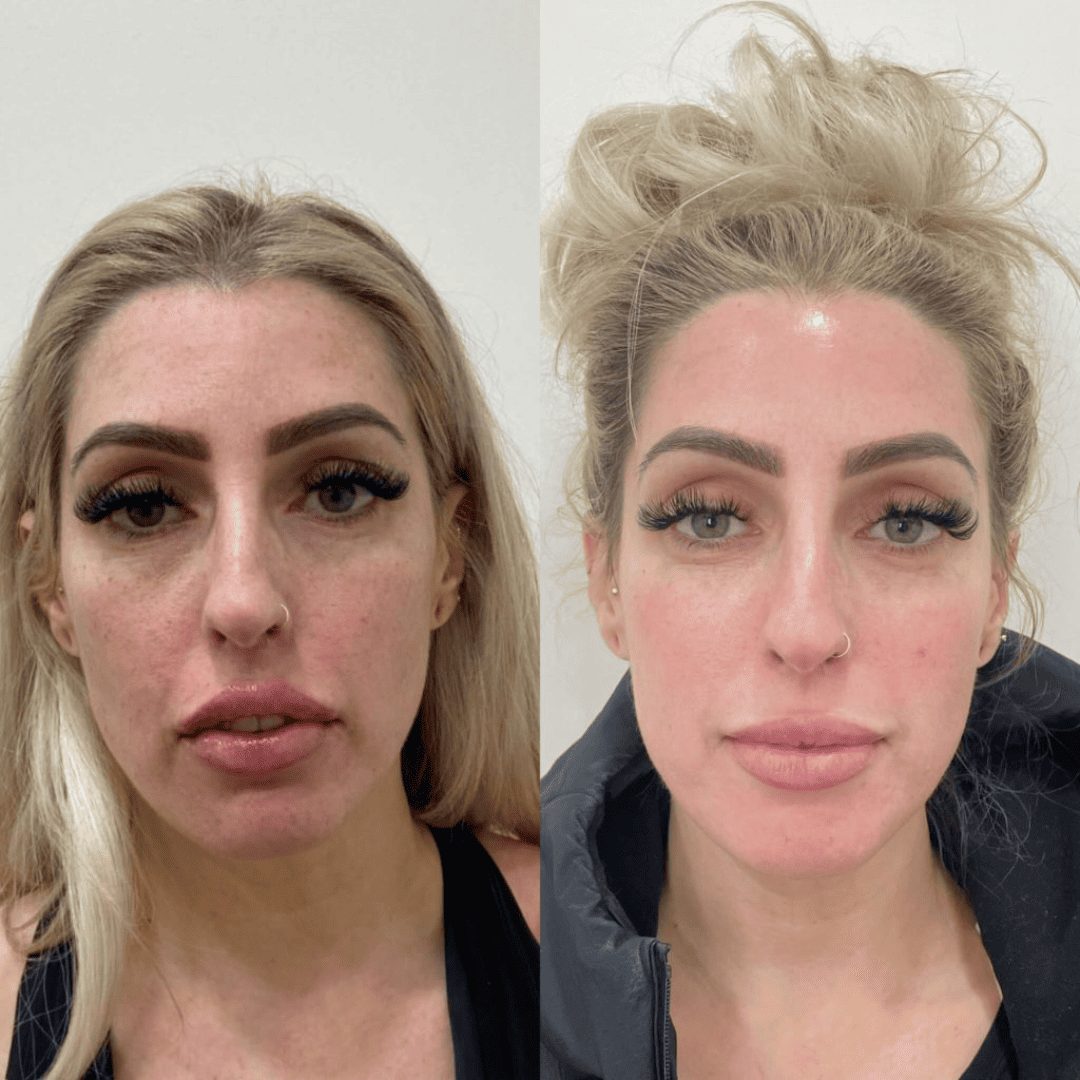 Facial rejuvenation, before and after