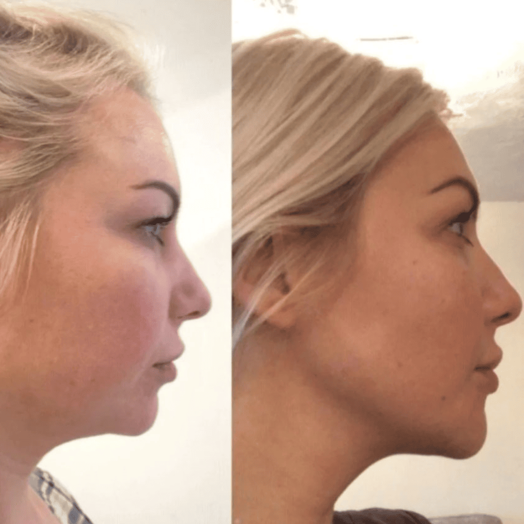 Jawline and under-chin, before and after