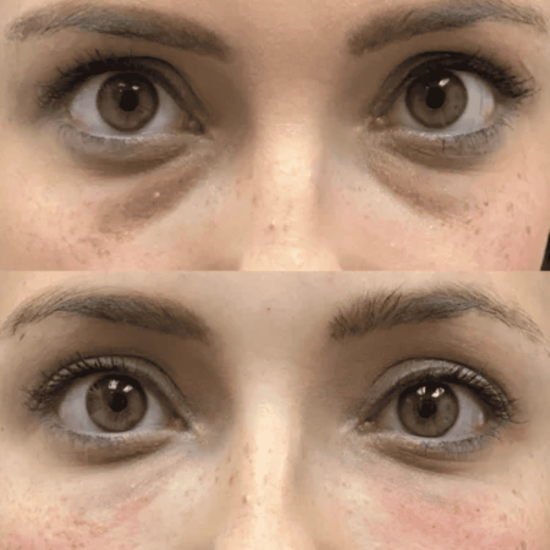 Dark circles, before and after