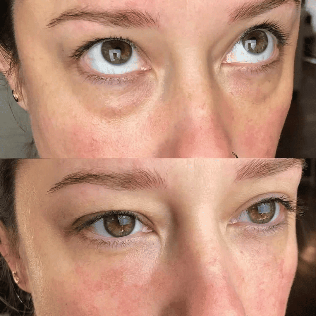 Under-eye hollows, before and after