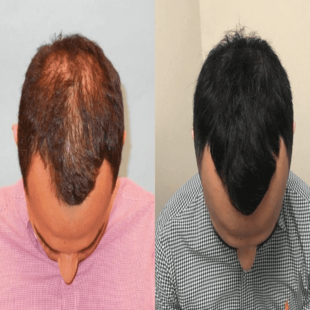 Hair PRP results, before and after