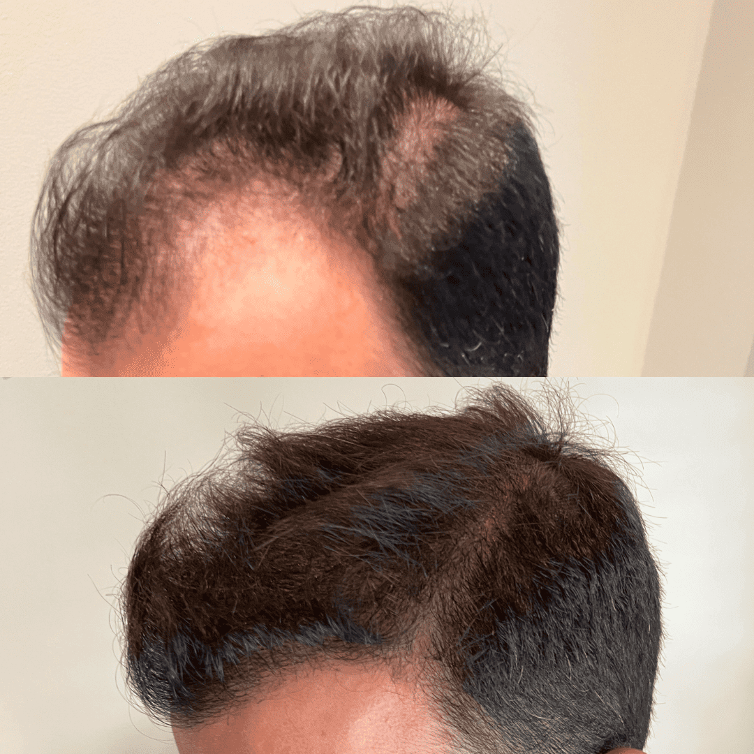 Overall thickness, before and after