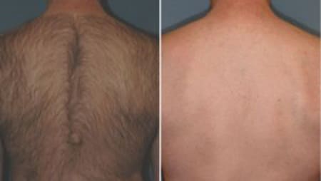 Back, before and after
