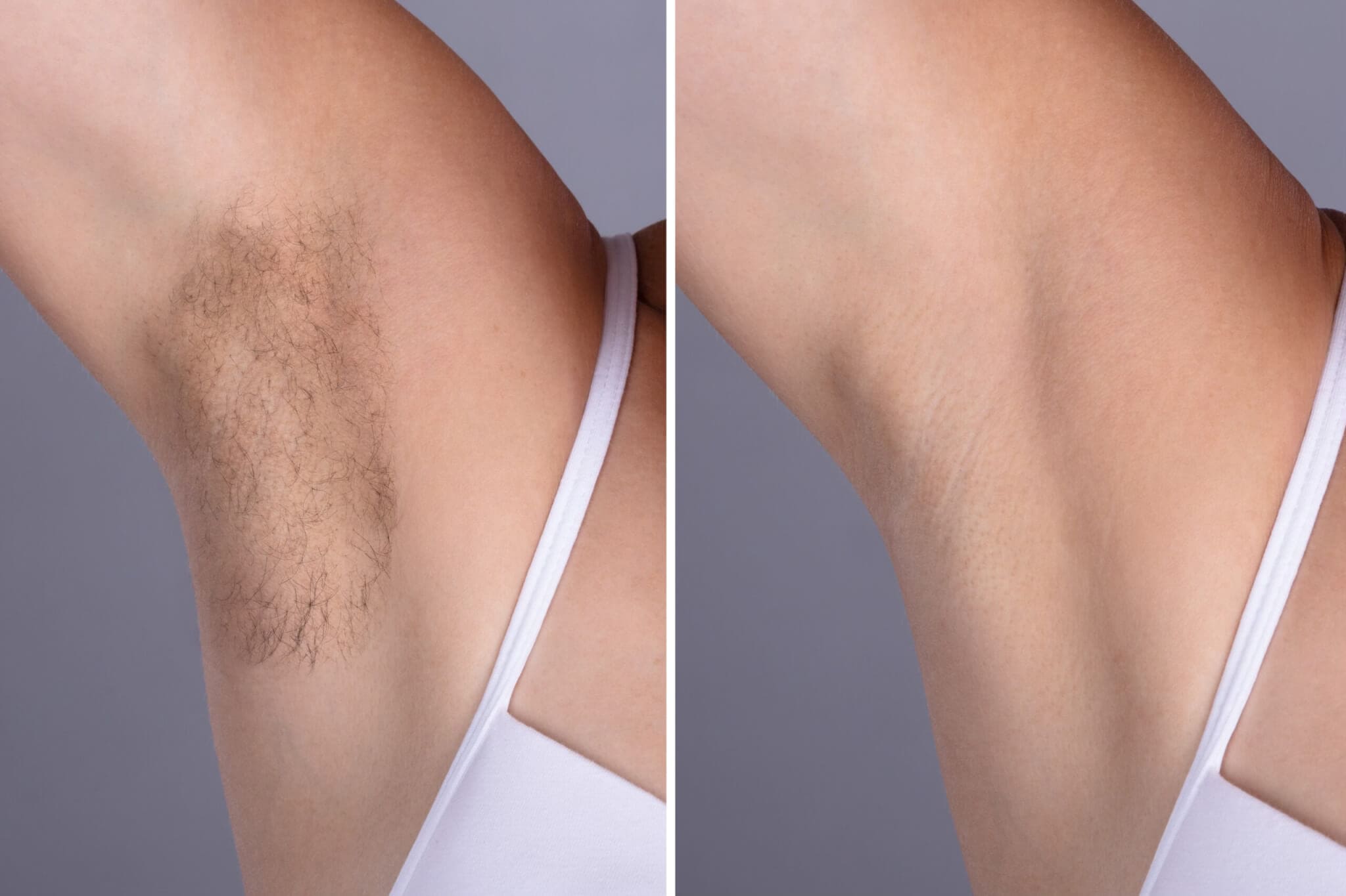 Underarm, before and after