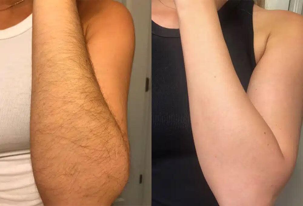 Arm, before and after