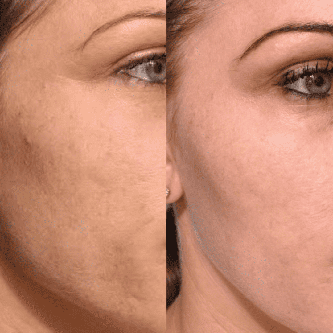 Dullness and hydration, before and after