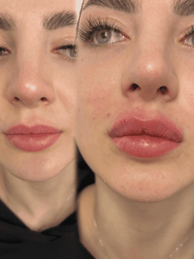 Fuller, smoother lips, before and after