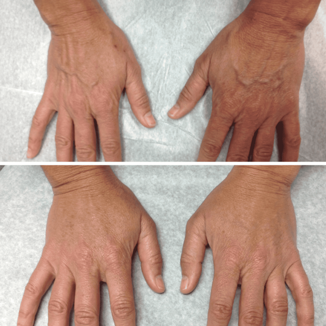 Hand rejuvenation, before and after