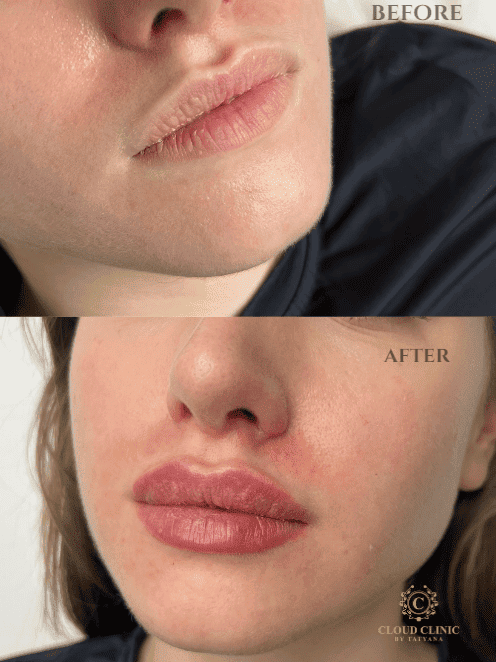 Definition and balance, before and after