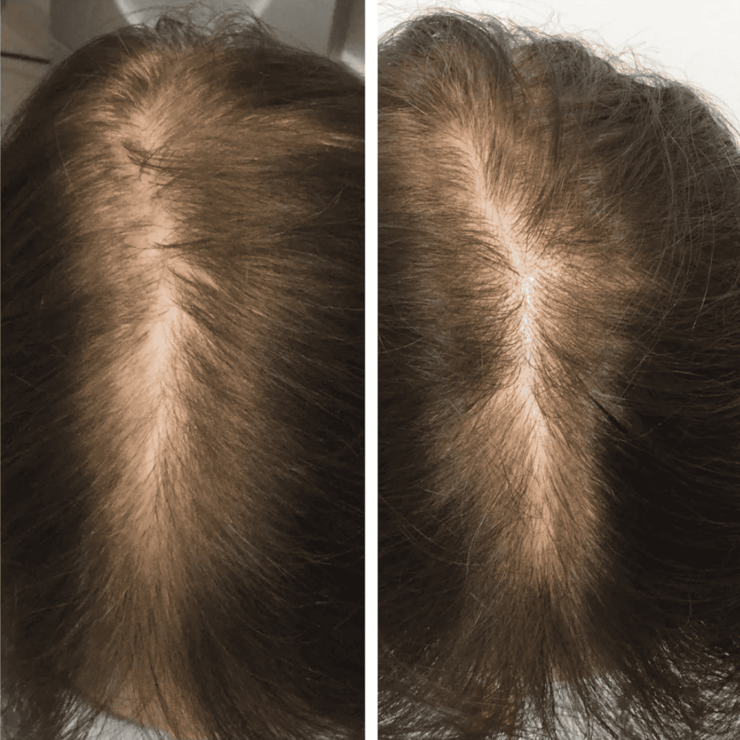Crown density, before and after