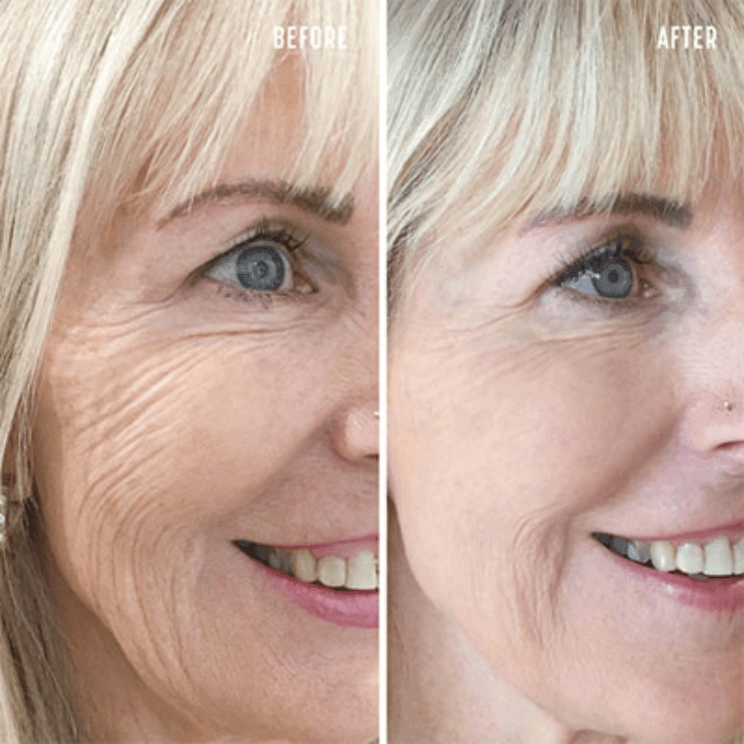 Texture and post-acne marks, before and after