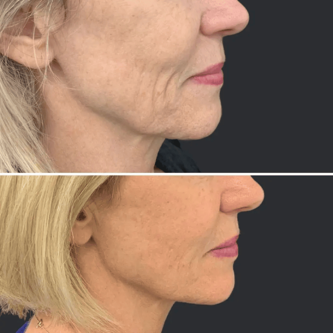 Jawline and jowls, before and after