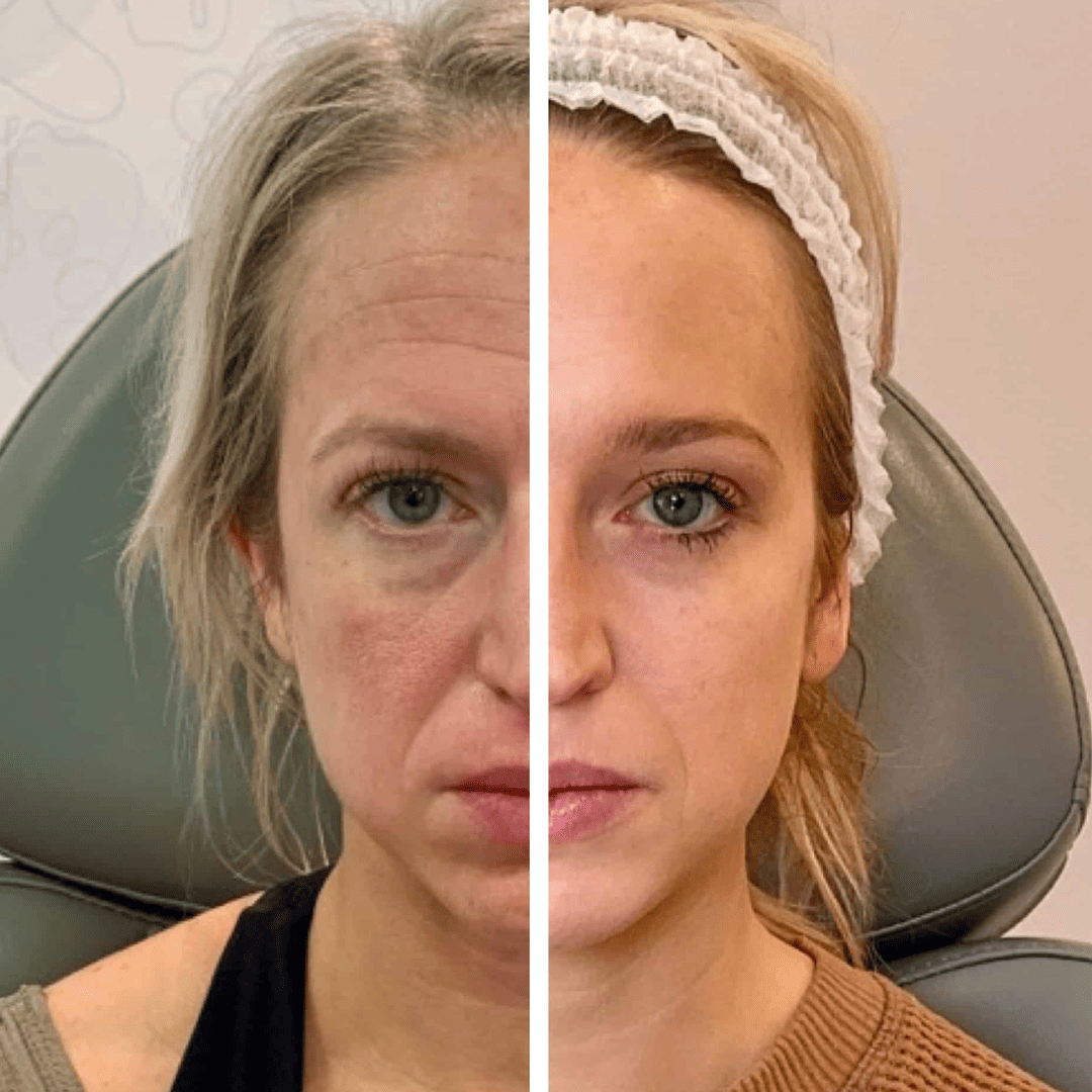 Skin texture and firmness, before and after