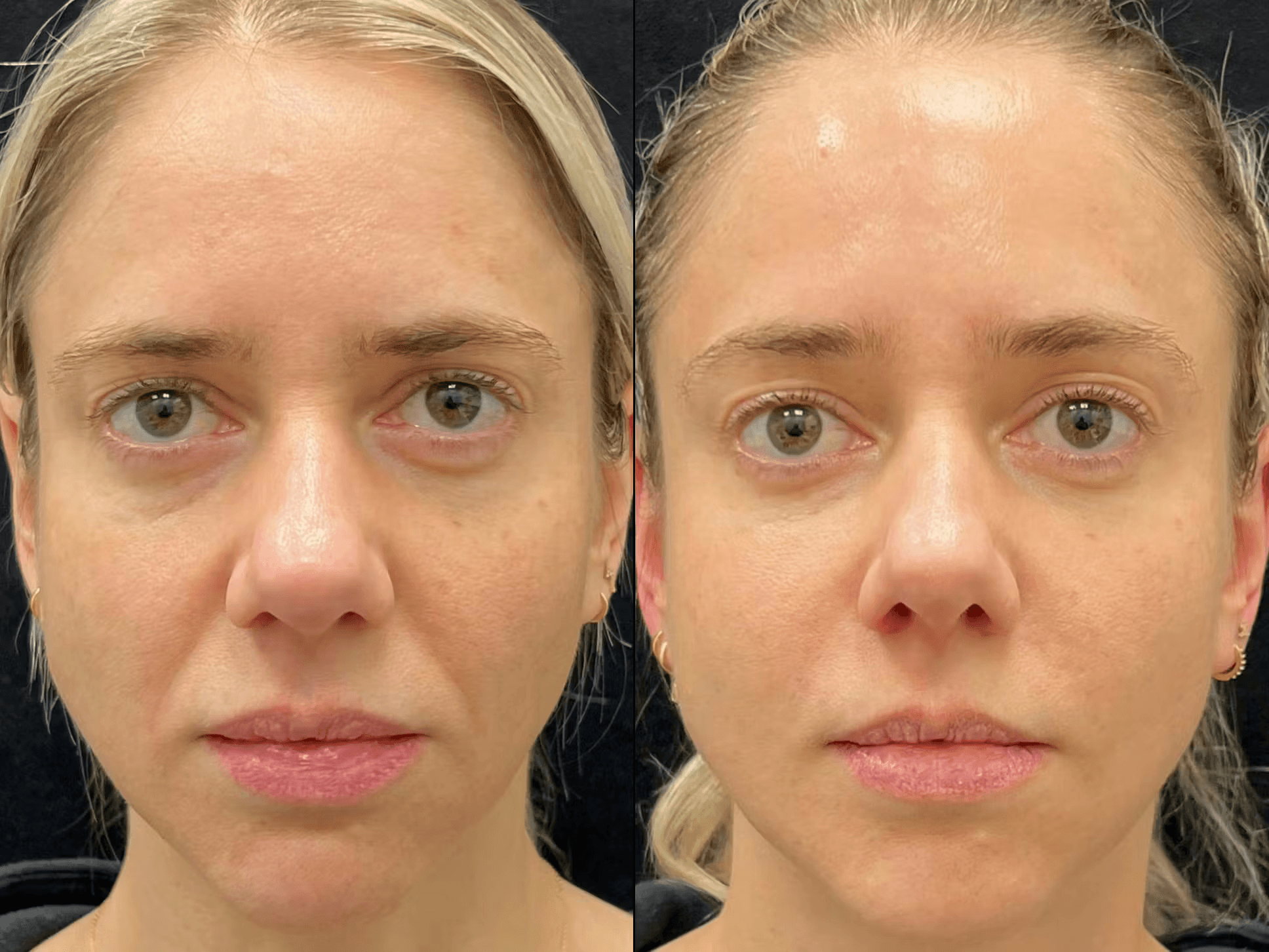 Jawline and chin, before and after