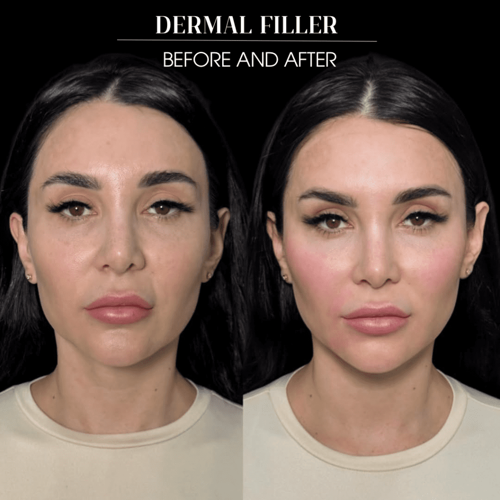 Cheek and jaw contour, before and after